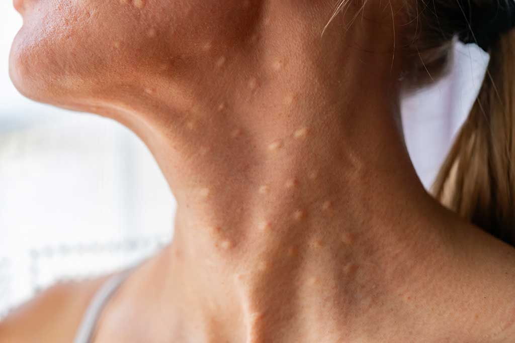 Tout savoir sur la mésothérapie chez le dr Guatrd à Libourne